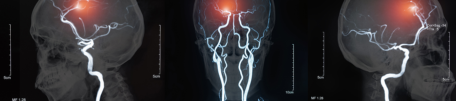 Who Is at Risk for a Stroke?