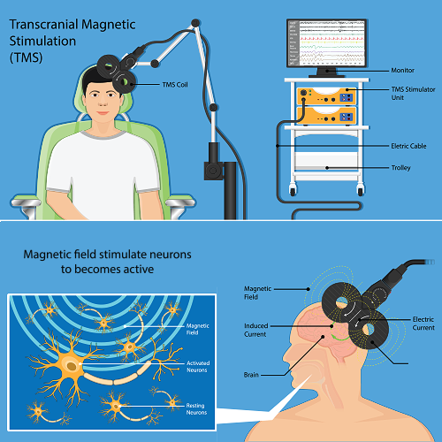 Transcranial Magnetic Stimulation (TMS)