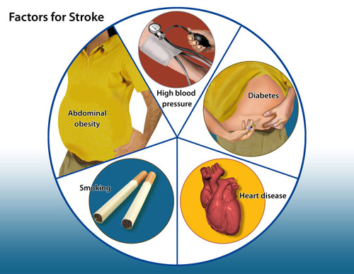 Who Is at Risk for a Stroke? | CNS TBI Rehab