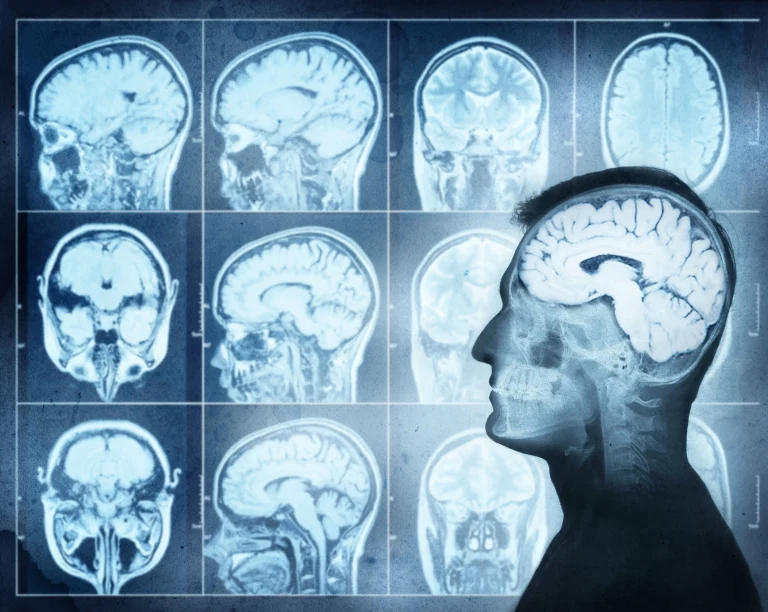 MRIs of Brain